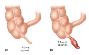 Appendicitis WC-Voetsteun - Natuurlijk gezond - Santura