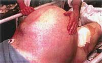 distended_abdomen Schokkende beelden - Natuurlijk gezond - Santura